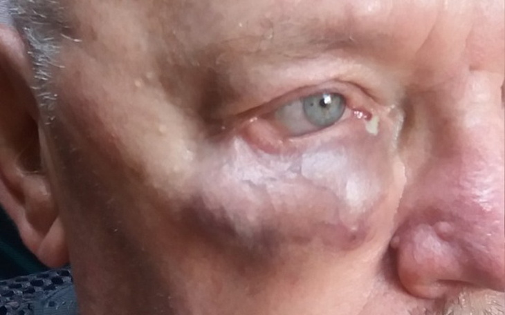 Zbiórka ratowanie oka  Michala Walkowicz - zdjęcie główne