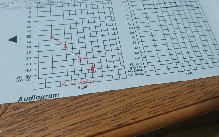 Zbiórka Aparat słuchowy prawego ucha - zdjęcie główne