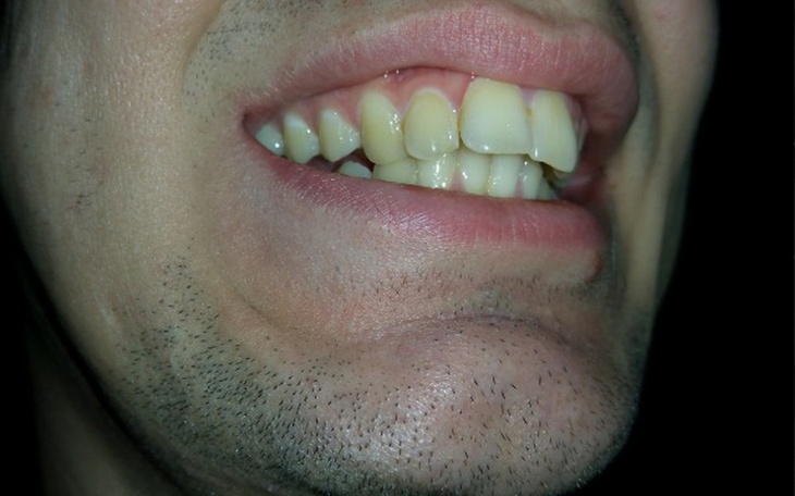 Zbiórka Aparat ortodontyczny na zęby - zdjęcie główne