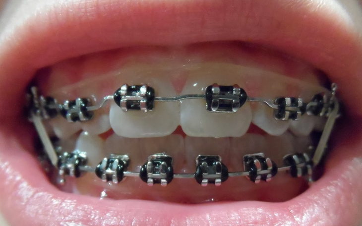 Zbiórka na aparat na zęby. - zdjęcie główne