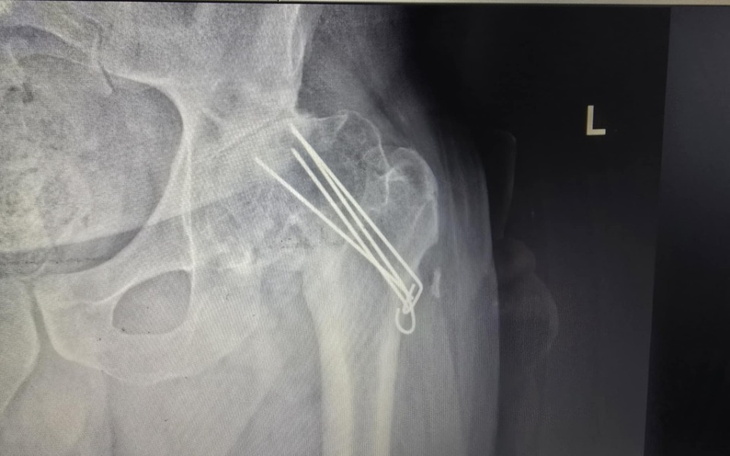 Rentgen pokazujący kontuzję barku z metalowymi elementami.