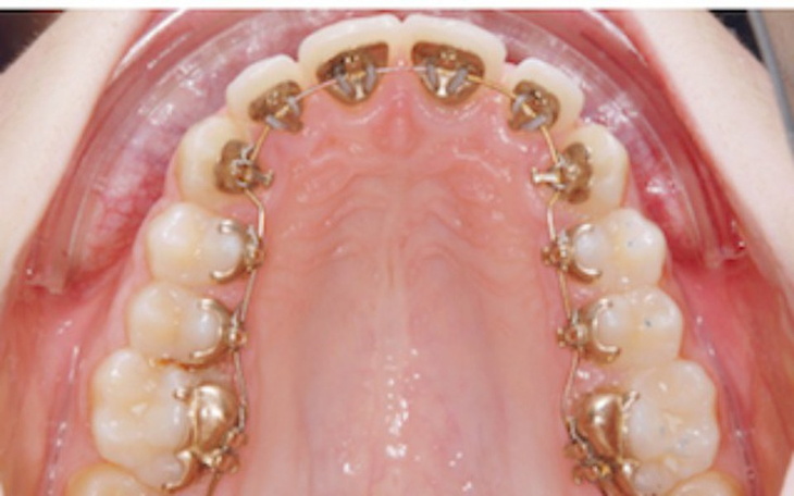 Zbiórka Aparat lingwalny - zdjęcie główne