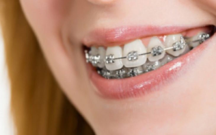 Zbiórka Stały aparat, górne i dolne zęby - zdjęcie główne