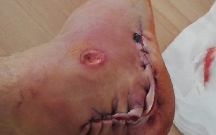 Zbiórka Rehabilitacja zgniecionej pięty - zdjęcie główne