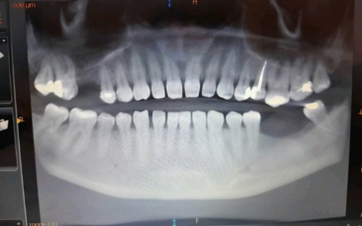 Rentgen zębów, ukazujący uzębienie pacjenta.