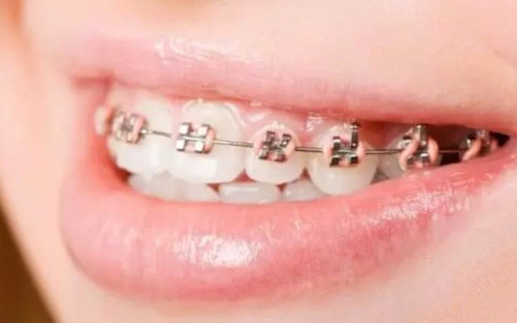 Zbiórka na aparat ortodontycznyyy - zdjęcie główne