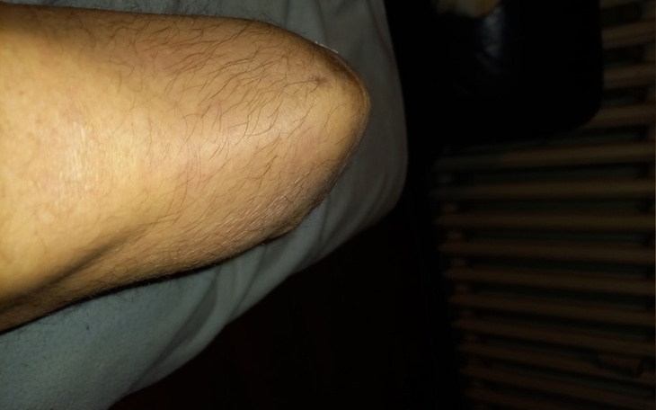 Zbiórka Potrzebuję protezy podudzia - zdjęcie główne