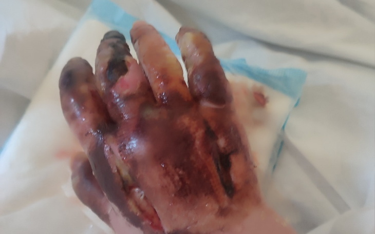 Zbiórka Zbieramy na protezę palca - zdjęcie główne