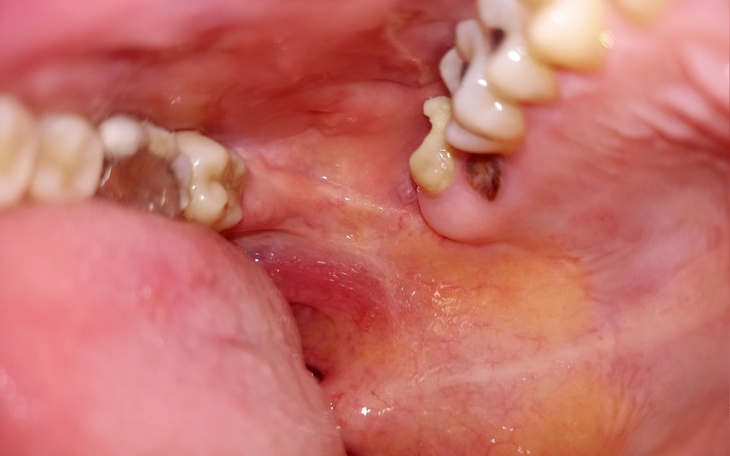 Zbiórka Na usunięcie zębów. - zdjęcie główne