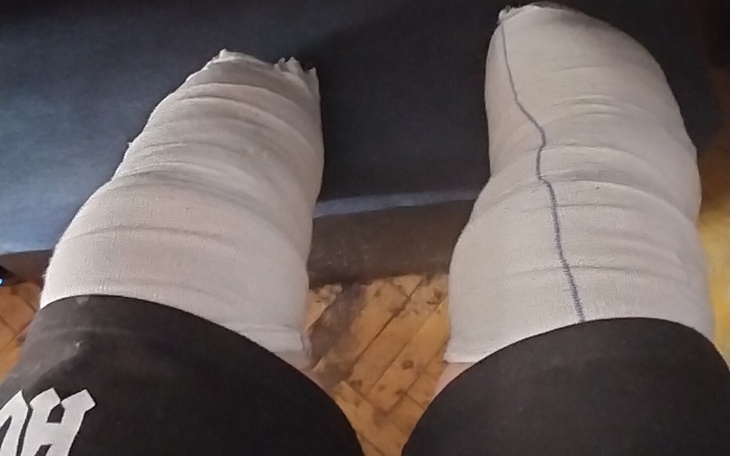 Zbiórka Protezy podudzia x2 - zdjęcie główne