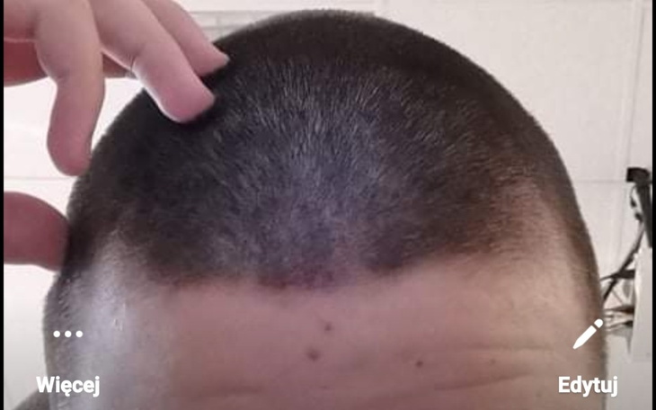 Zbiórka Zbieram na przeszczep włosów.... - zdjęcie główne