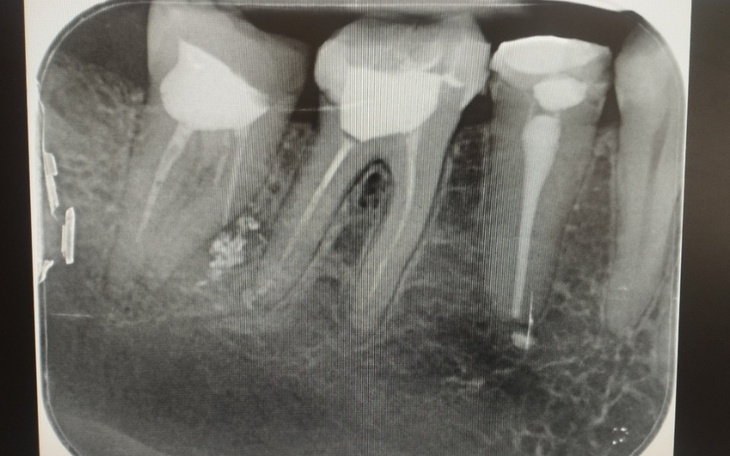 Zbiórka Na naprawę zębów kanałowych - zdjęcie główne