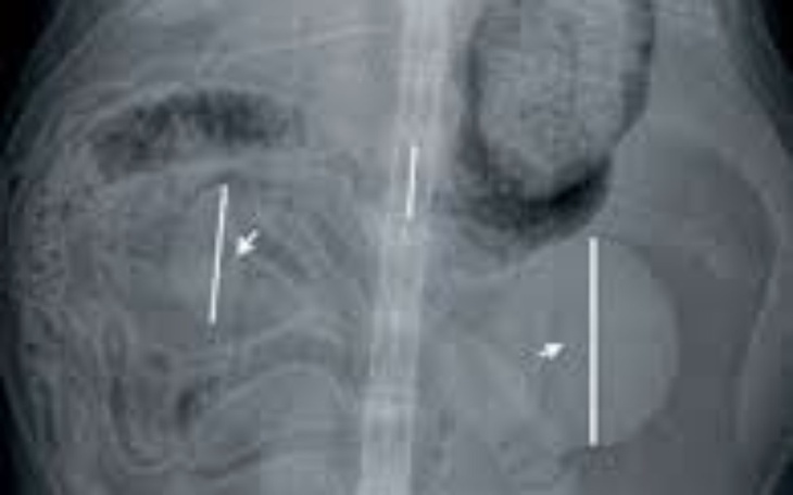 Zdjęcie rentgenowskie pokazujące wewnętrzne struktury ciała.