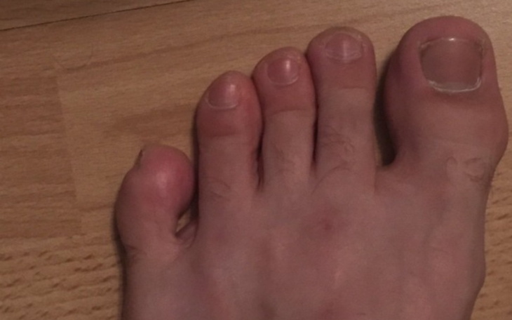 Zbiórka na odcięcie palca u stopy - zdjęcie główne