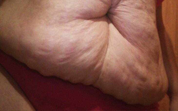 Zbiórka Plastyka brzucha po ciąży - zdjęcie główne