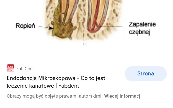 Zbiórka Leczenie zębów kanałowe - zdjęcie główne