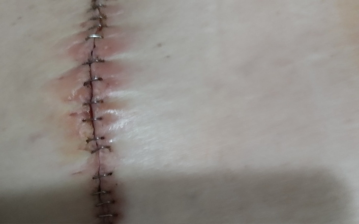 Blisko zdjęcie blizny na skórze, po operacji.