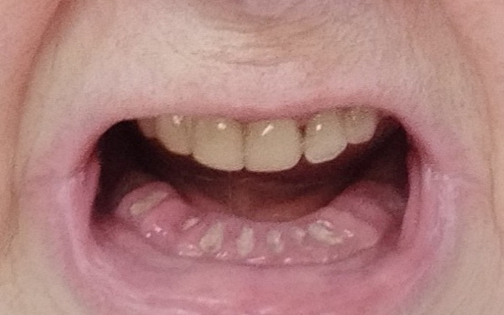 Zbiórka Na protezę przy bezzębiu - zdjęcie główne