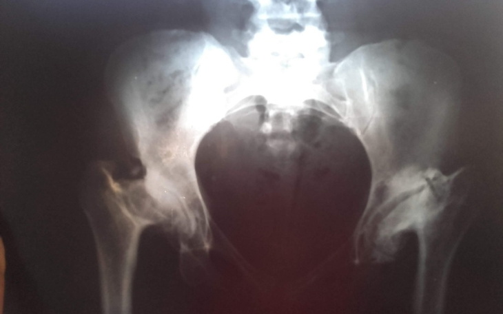 Zbiórka Rekonstrukcja terapia stawów - zdjęcie główne