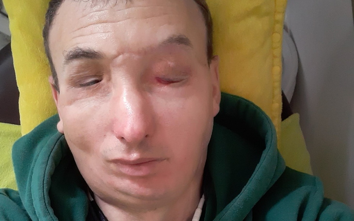 Mężczyzna leży na poduszce, z widocznymi zmianami na twarzy.