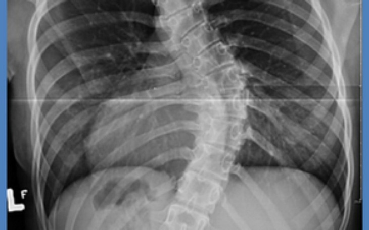 Zbiórka Leczenie skoliozy kręgosłupa - zdjęcie główne