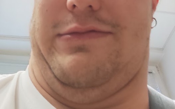 Zbiórka Zabieg liposukcji podbródka - zdjęcie główne