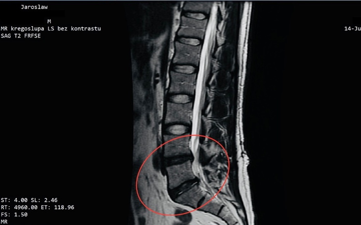 Zdjęcie MRI kręgosłupa, pokazujące szczegóły medyczne.