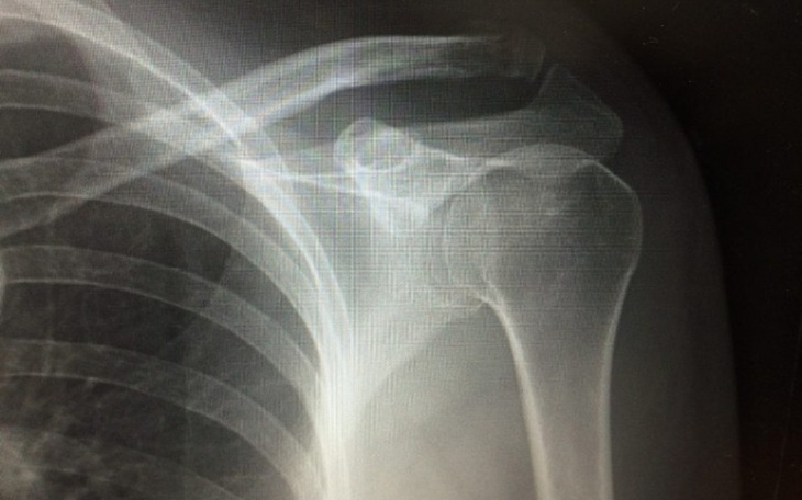 Zdjęcie rentgenowskie barku z widocznym uszkodzeniem.
