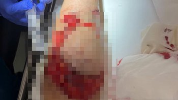 Zbiórka Dla Sylwii - powrót do zdrowia - miniaturka zdjęcia