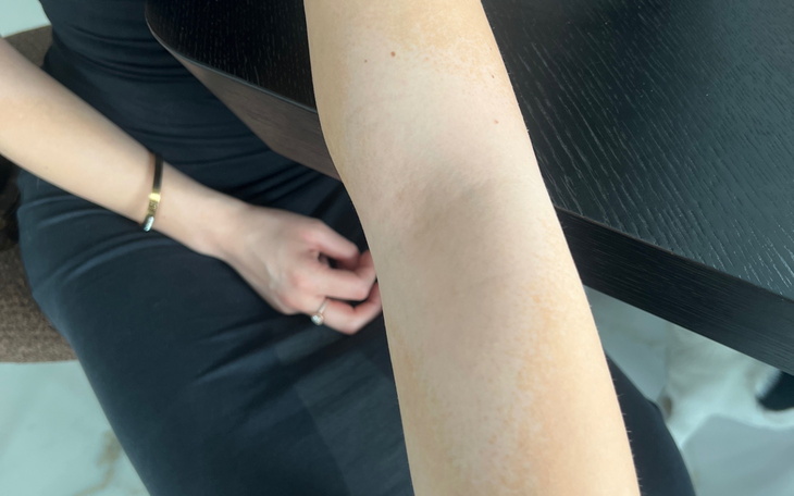 Zbliżenie na rękę z widocznymi śladami na skórze, w tle czarna sukienka.