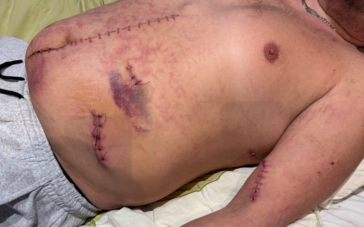 Zdjęcie pacjenta po operacji z widocznymi szwami na brzuchu.