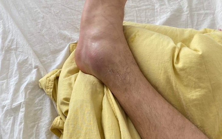 Zbiórka Na operacje kostki u nogi - zdjęcie główne