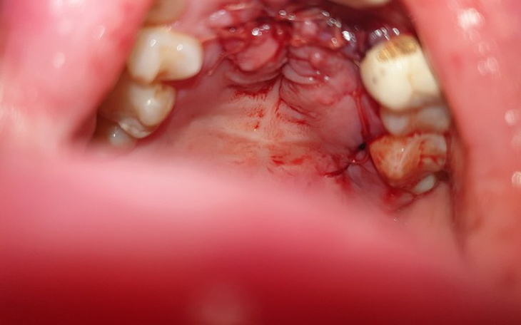 Zbiórka Rekonstrukcja szczęki & dziąsła - zdjęcie główne