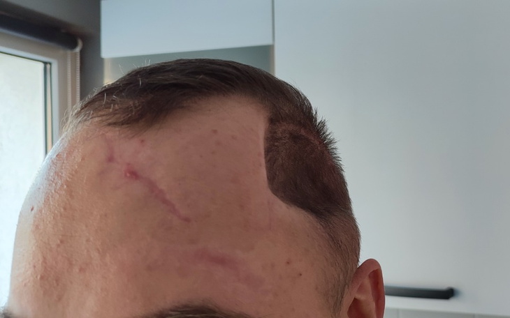 Zbiórka Rekonstrukcja czaszki Jakuba - zdjęcie główne