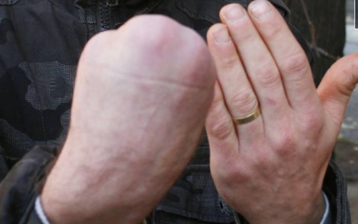 Zbiórka Na protezę palców dłoni - zdjęcie główne