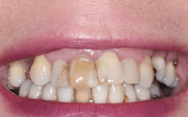 Uśmiechnięte zęby z widocznymi przebarwieniami.