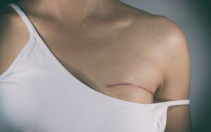 Zbiórka Leczenie jednej piersi - zdjęcie główne