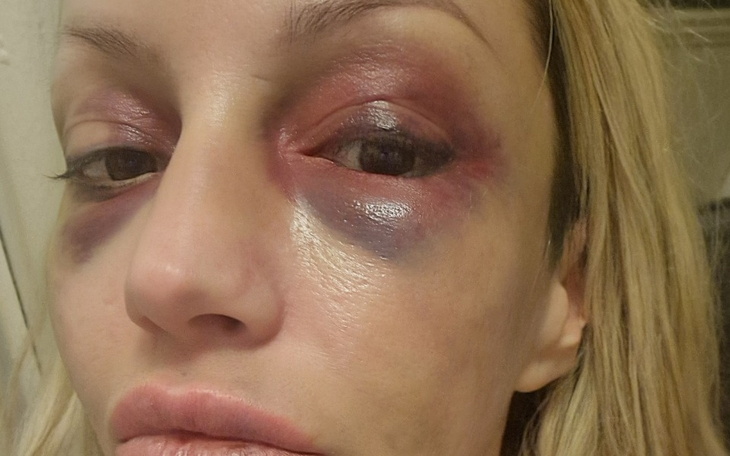 Kobieta z siniakami na twarzy.