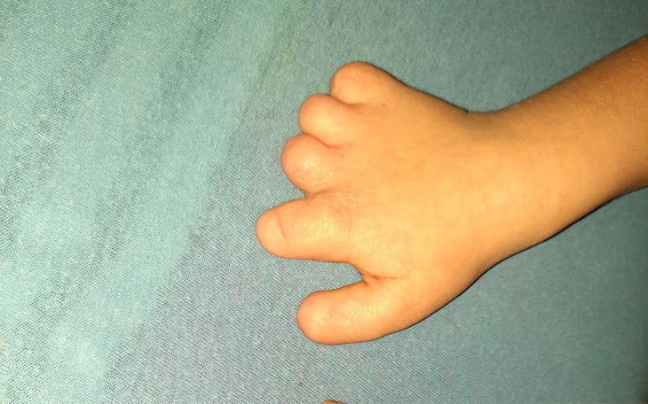 Zbiórka Nowa rączka Mai - zdjęcie główne