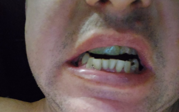 Zbliżenie na usta mężczyzny z widocznymi zębami.