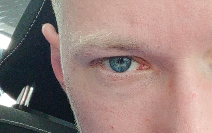 Zbiórka Operacja oczu po zapaleniach rog - zdjęcie główne