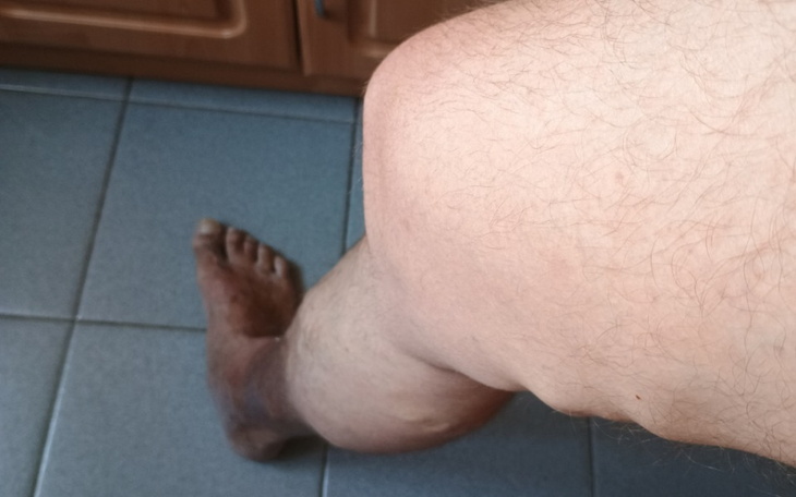 Zbiórka Zbiórka na operację żylaków nogi - zdjęcie główne