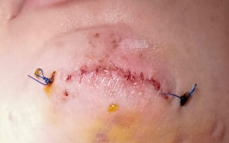 Zbiórka Na usunięcie blizny po wypadku - zdjęcie główne