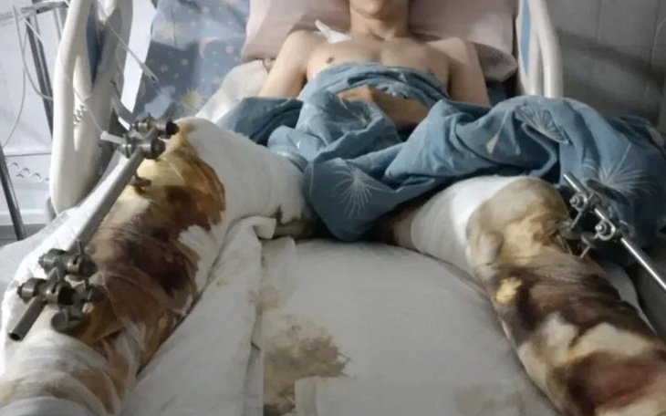 Młody chłopak w szpitalnym łóżku z opatrunkami na nogach.