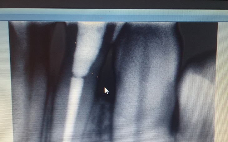 Zbiórka Implant zęba/dolna 2 - zdjęcie główne