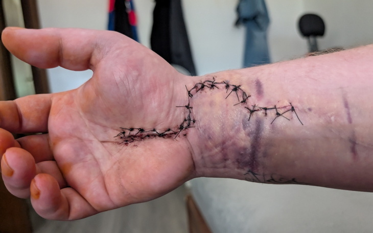 Ręka z szwami po operacji, widoczna rana.