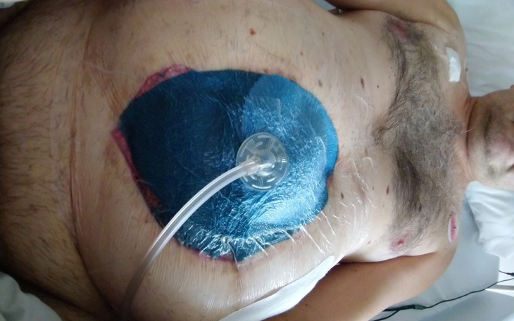 Mężczyzna z opatrunkiem na klatce piersiowej w szpitalu.