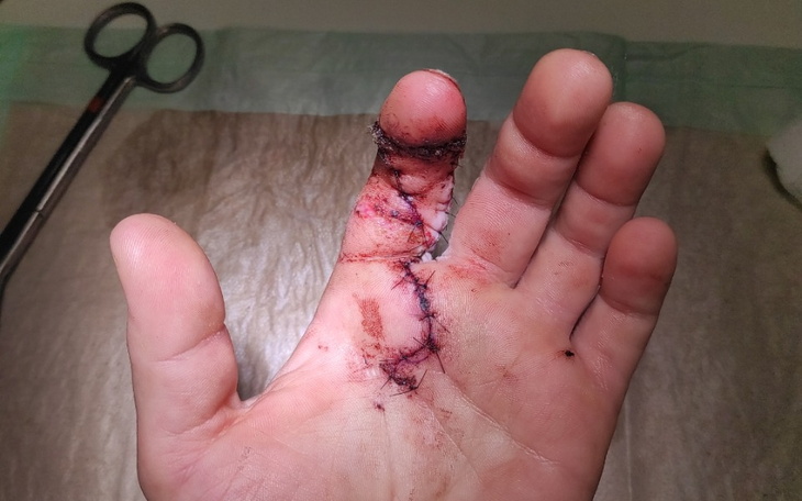 Zbiórka Na rehabilitację uciętego palca - zdjęcie główne