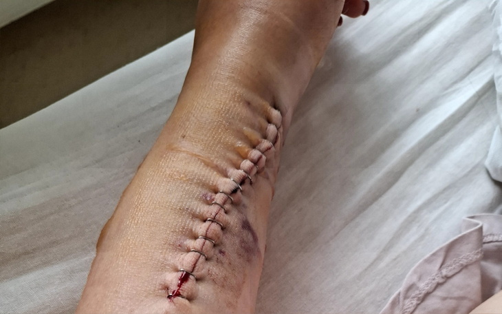 Zbliżenie na bliznę na ręce po operacji, widoczna na skórze.