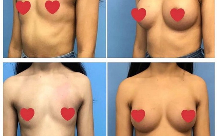 Zbiórka Zbieram na nowe cycki - zdjęcie główne